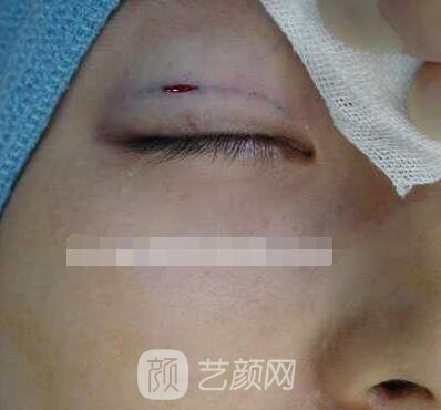 張嬌嬌醫(yī)生做的小切口雙眼皮手術(shù)案例