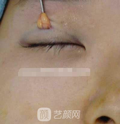 張嬌嬌醫(yī)生做的小切口雙眼皮手術(shù)案例