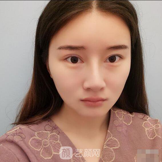 顴骨內(nèi)推真實案例，小臉網(wǎng)紅模板臉型