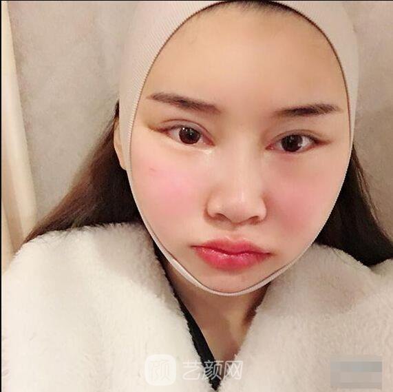 顴骨內(nèi)推真實案例，小臉網(wǎng)紅模板臉型