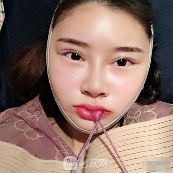 顴骨內(nèi)推真實案例，小臉網(wǎng)紅模板臉型