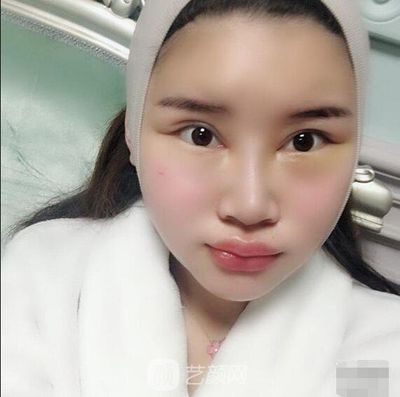 顴骨內(nèi)推真實案例，小臉網(wǎng)紅模板臉型