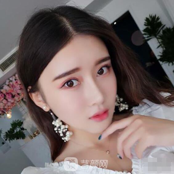 顴骨內(nèi)推真實案例，小臉網(wǎng)紅模板臉型