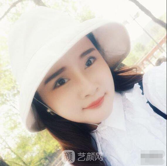 顴骨內(nèi)推真實案例，小臉網(wǎng)紅模板臉型