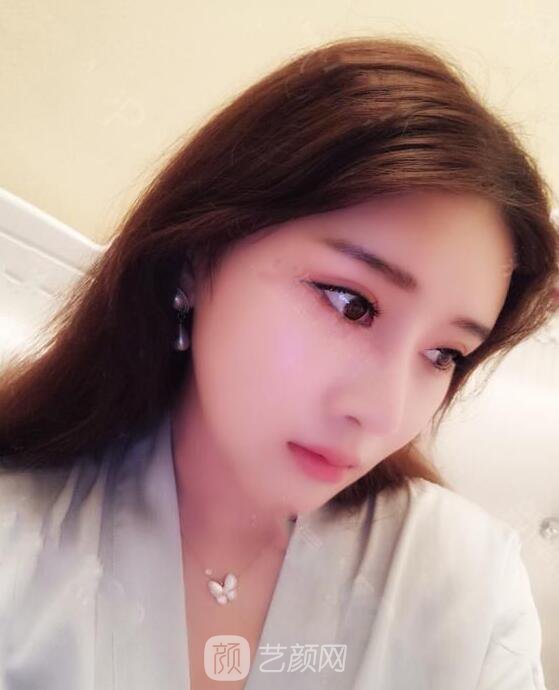 顴骨內(nèi)推真實案例，小臉網(wǎng)紅模板臉型