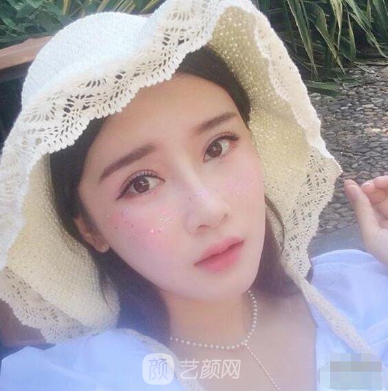 顴骨內(nèi)推真實案例，小臉網(wǎng)紅模板臉型