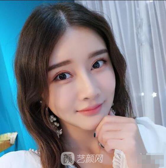 顴骨內(nèi)推真實案例，小臉網(wǎng)紅模板臉型