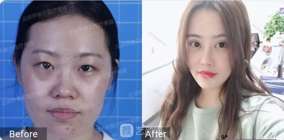 伊美爾幸福李輝靈動(dòng)面部年輕化術(shù)后兩個(gè)月恢復(fù)日記~