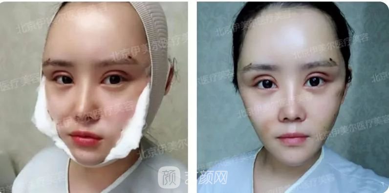 伊美爾幸福李輝靈動(dòng)面部年輕化術(shù)后兩個(gè)月恢復(fù)日記~