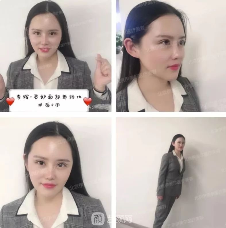 伊美爾幸福李輝靈動(dòng)面部年輕化術(shù)后兩個(gè)月恢復(fù)日記~