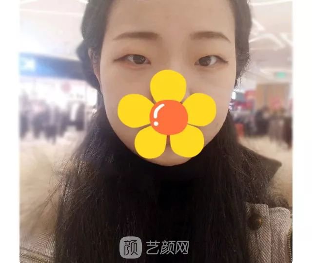 脂美人雙眼皮手術(shù)大公開！我終于整容了！