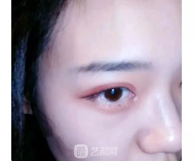 脂美人雙眼皮手術(shù)大公開！我終于整容了！