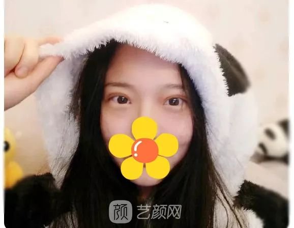 脂美人雙眼皮手術(shù)大公開！我終于整容了！