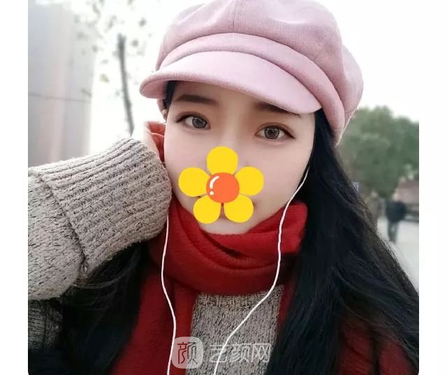 脂美人雙眼皮手術(shù)大公開！我終于整容了！