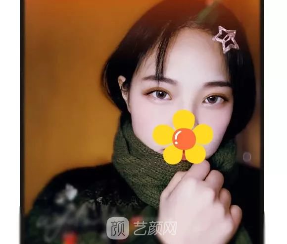 脂美人雙眼皮手術(shù)大公開！我終于整容了！