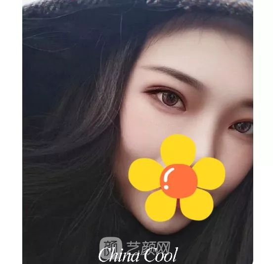 脂美人雙眼皮手術(shù)大公開！我終于整容了！