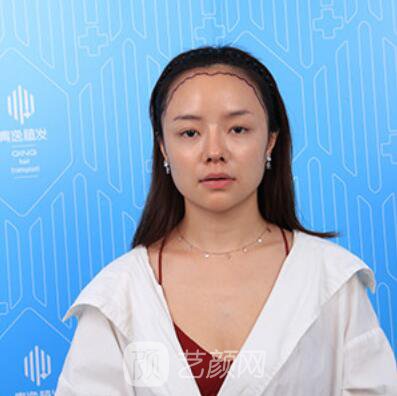 做好發(fā)際線后堪比微調(diào)的真實(shí)經(jīng)歷分享