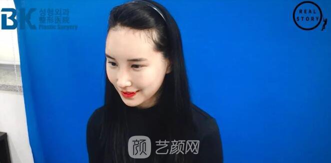 【新西蘭美女整形日記】鼻部手術(shù)+面部脂肪移植——BK整形醫(yī)院