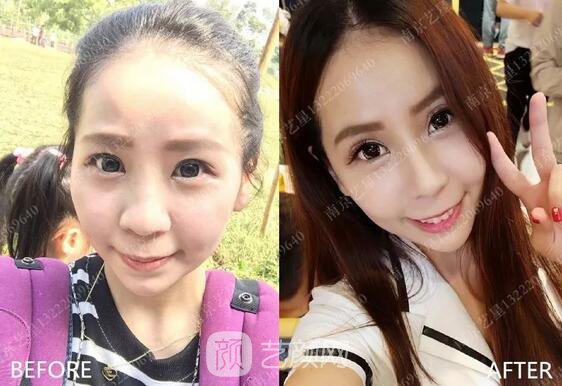 只需要5分鐘，我的鼻子變高了！——南京藝星玻尿酸隆鼻~