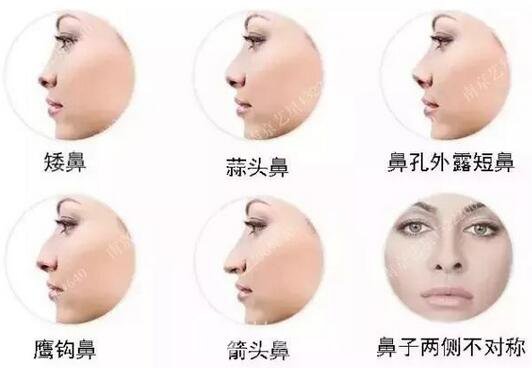 只需要5分鐘，我的鼻子變高了！——南京藝星玻尿酸隆鼻~