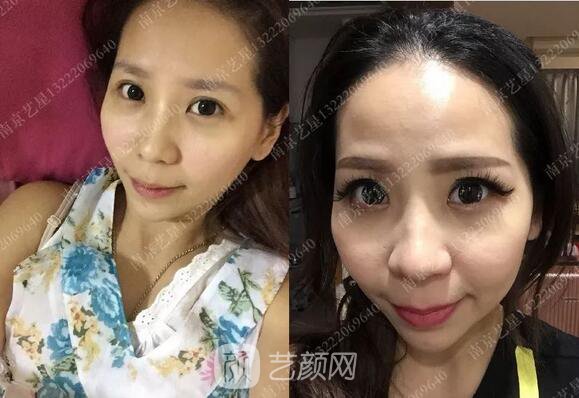 只需要5分鐘，我的鼻子變高了！——南京藝星玻尿酸隆鼻~