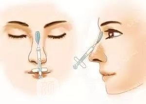 只需要5分鐘，我的鼻子變高了！——南京藝星玻尿酸隆鼻~