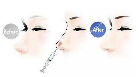 只需要5分鐘，我的鼻子變高了！——南京藝星玻尿酸隆鼻~