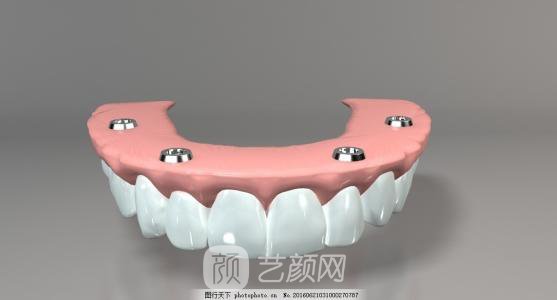 上海九院種植牙多少錢?