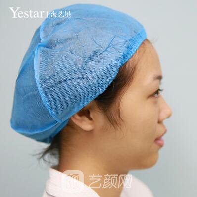 上海藝星切開雙眼皮案例，論雙眼皮的重要性