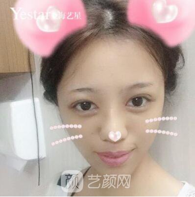 上海藝星切開雙眼皮案例，論雙眼皮的重要性