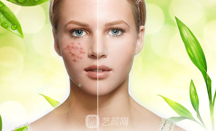 如何用新鮮蘆薈祛痘