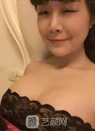 產(chǎn)后媽媽假體隆胸真實案例恢復(fù)過程