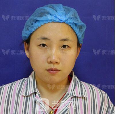 北京紫潔醫(yī)療美容全切雙眼皮案例過程恢復(fù)