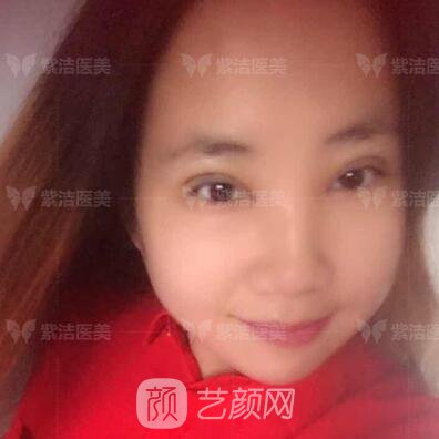北京紫潔醫(yī)療美容全切雙眼皮案例過程恢復(fù)