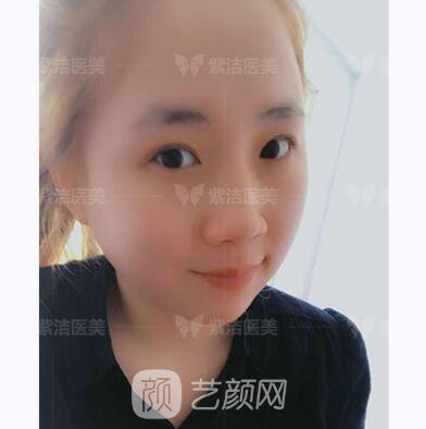 北京紫潔醫(yī)療美容全切雙眼皮案例過程恢復(fù)