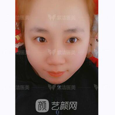 北京紫潔醫(yī)療美容全切雙眼皮案例過程恢復(fù)