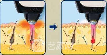 OPT脫毛怎樣做術(shù)后護理