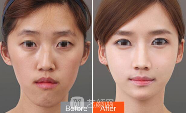 自體脂肪填充淚溝能維持多久?