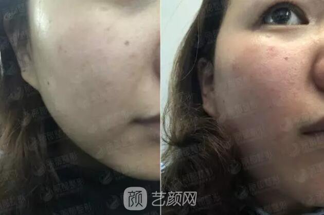 祛紅血絲的N種方式，讓你告別尷尬“紅臉蛋兒”！