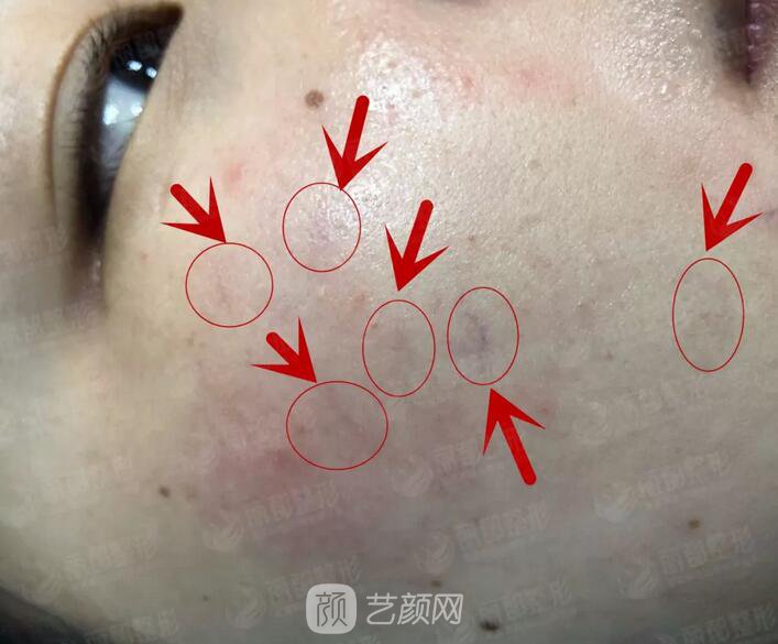 祛紅血絲的N種方式，讓你告別尷尬“紅臉蛋兒”！