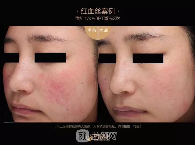 祛紅血絲的N種方式，讓你告別尷尬“紅臉蛋兒”！