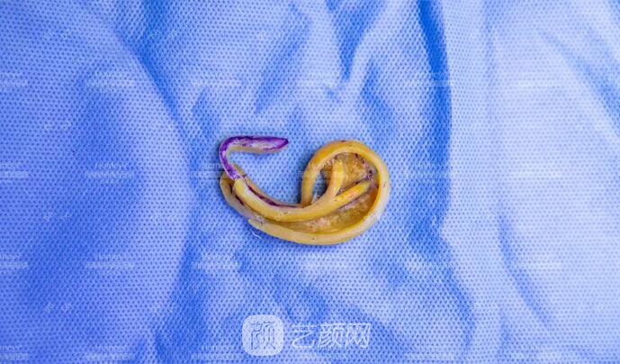 【取肋軟骨會影響孩子胸廓發(fā)育嗎？】