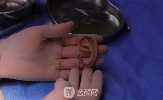 【再造的耳朵軟硬度摸起來和正常耳朵一樣嗎？】