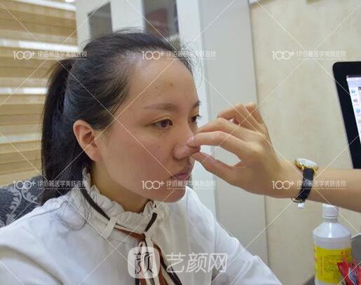 耳軟骨隆鼻術(shù)后一個(gè)月的果，真實(shí)日記一則給大家看看~