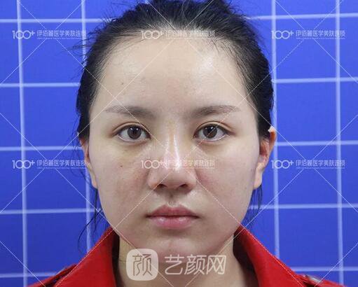 耳軟骨隆鼻術(shù)后一個(gè)月的果，真實(shí)日記一則給大家看看~