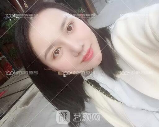 耳軟骨隆鼻術(shù)后一個(gè)月的果，真實(shí)日記一則給大家看看~