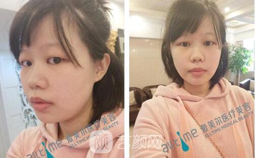 福州愛美爾王*全切雙眼皮真實(shí)案例