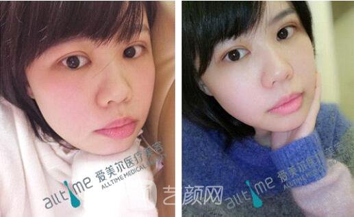 福州愛美爾王*全切雙眼皮真實(shí)案例