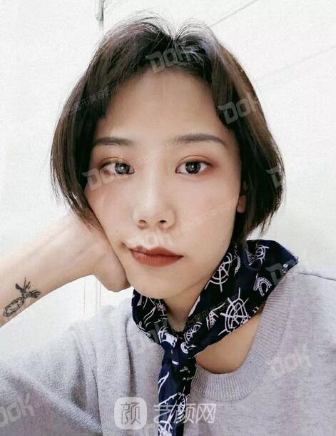 內(nèi)切祛眼袋果怎么樣？來(lái)瞧瞧這些照片就可能會(huì)有答案了哦~