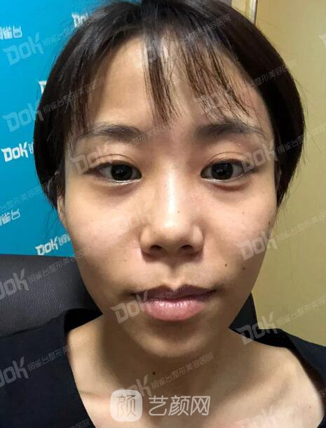 內(nèi)切祛眼袋果怎么樣？來(lái)瞧瞧這些照片就可能會(huì)有答案了哦~